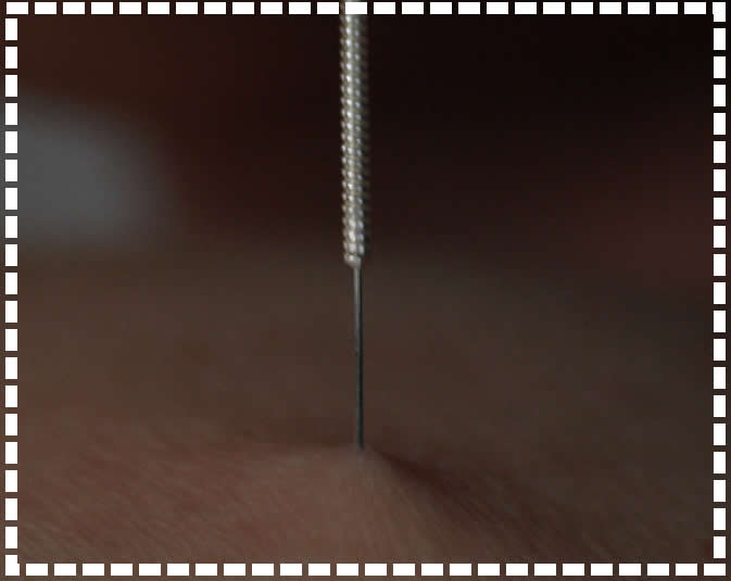 Nella foto un ago di agopuntura a forte ingrandimento in un corso di agopuntura del dottor Stefano Marcelli